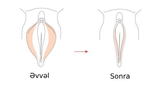 vaginoplastika əməliyyatı